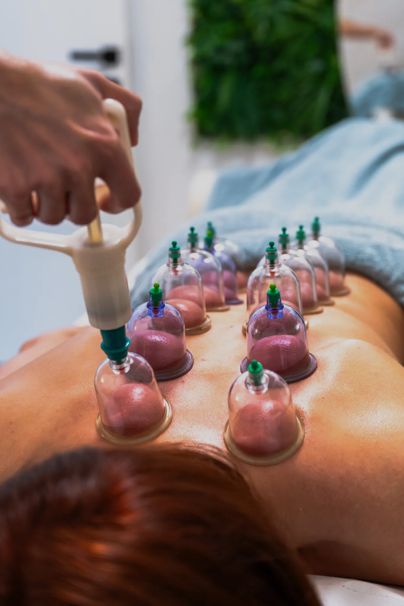 Cupping terapija
